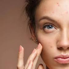 Glow On: Mastering the Art of Acne Control with Pro Skin Doctor