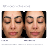 Acne Control Prebiotic Gel Cleanser