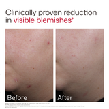 UV Clear Blemish-Prone & Oil Balancing SPF 50
